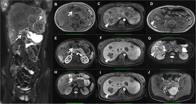 Case Report: a rare primary gastric choriocarcinoma revealed on 18F-FDG PET/CT